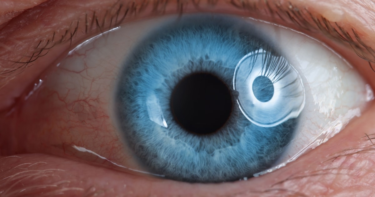 how does your vision change with a retinal tear